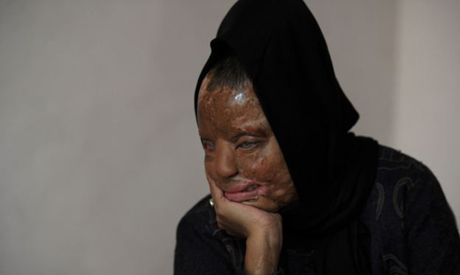 Acid attack victim-KBC winner1